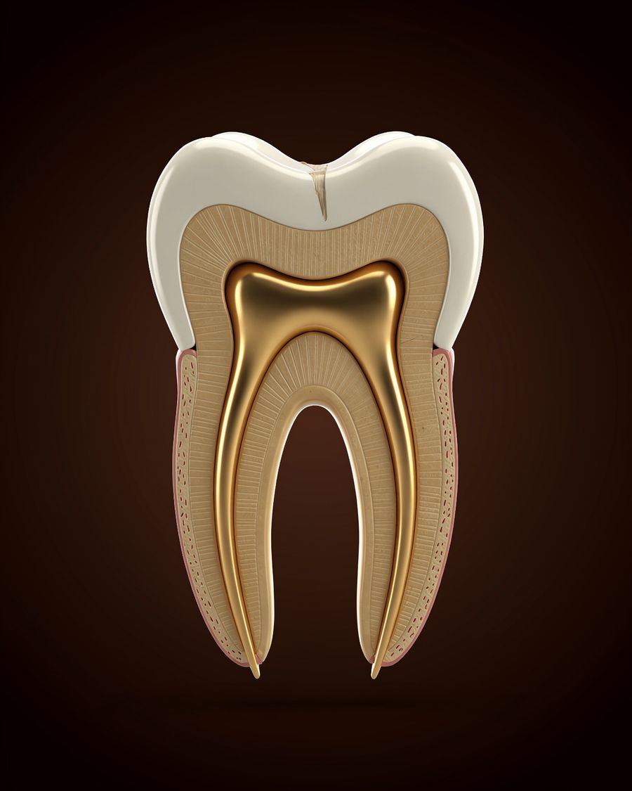 Representação em 3D da estrutura interna do dente no tratamento de canal no dente, na Aurielis Odontologia